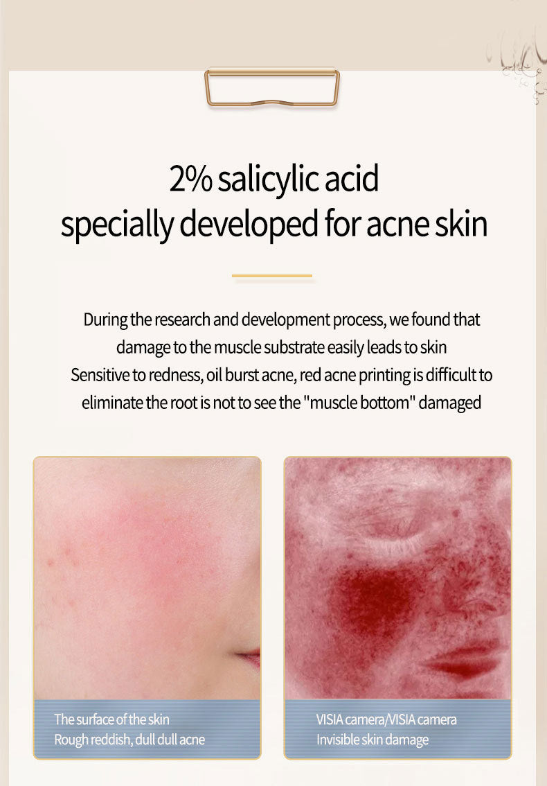 Acne Removing Salicylate Products - Balochistan LLC  Product information: Applicable people: general Specification: Standard specifications Applicable skin type: Universal Net content: 15 Category: facial essence Packing list: Essence liquid * 1pc Product Image: